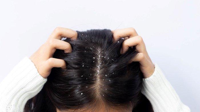 Masalah ketombe pada rambut bisa diatasi dengan menggunakan minyak lavender.