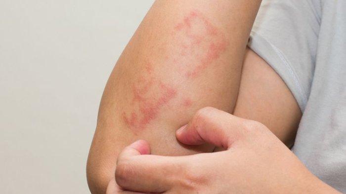 Masalah kulit pada penderita leukemia dapat kamu atasi dengan menggunakan daun jeruk purut.