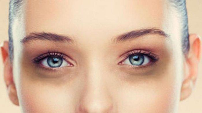 Mata panda dapat membuat seseorang kurang percaya diri