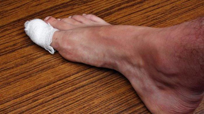Menaruh gumpalan kapas di bawah batas kuku ternyata bisa jadi obat alami cantengan di jempol kaki.