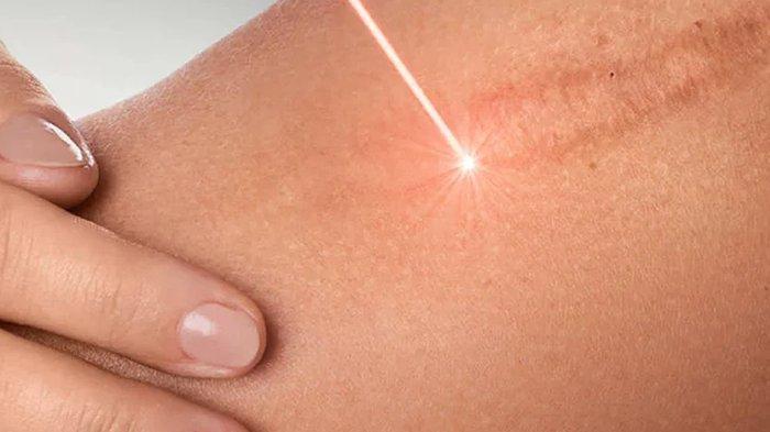 Menggunakan Terapi Laser