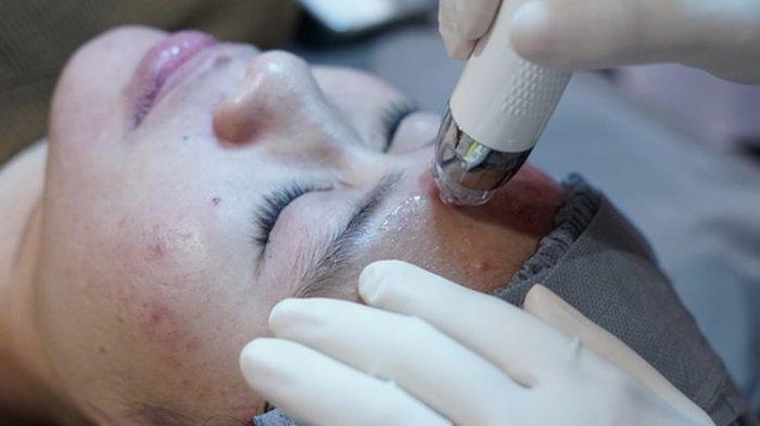 Ilustrasi perawatan Microneedling