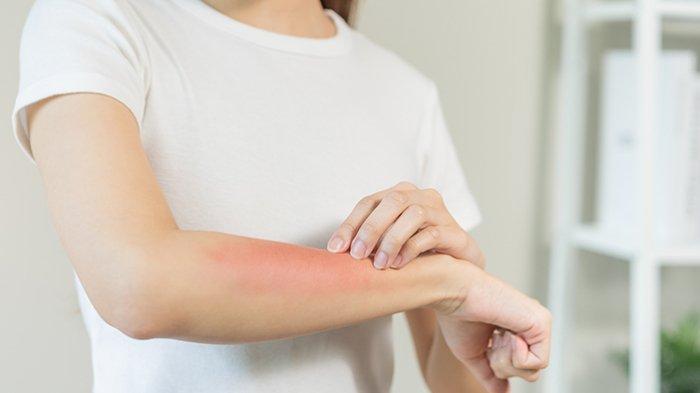 Minyak chamomile ini dapat membantu mengatasi iritasi di kulit