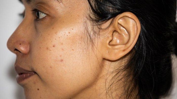 Munculnya hiperpigmentasi pada wajah merupakan salah satu tanda-tanda skin barrier rusak.