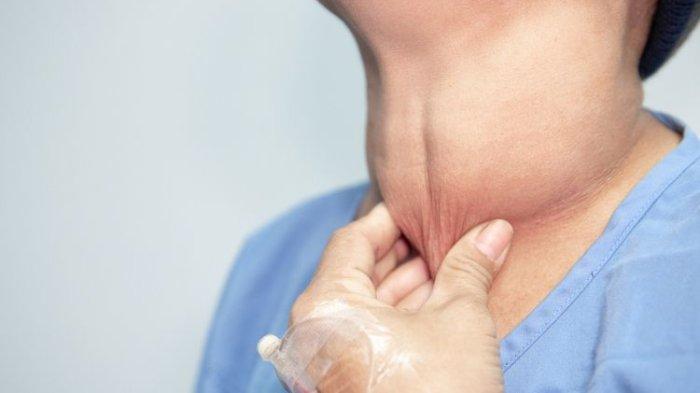 Ilustrasi penyakit gondok