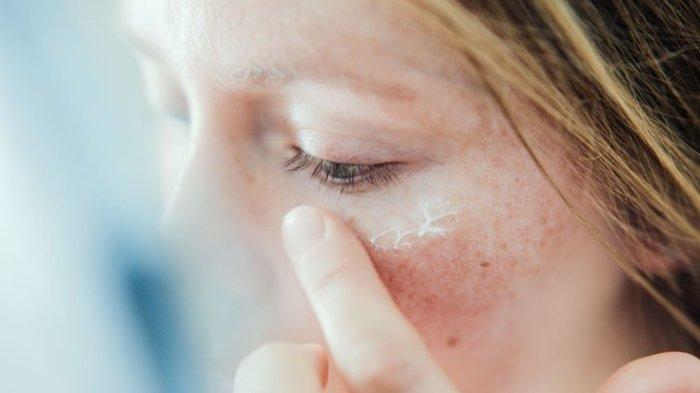 Gejala Psoriasis yang terjadi di kulit wajah bisa mengganggu penampilan seseoran.
