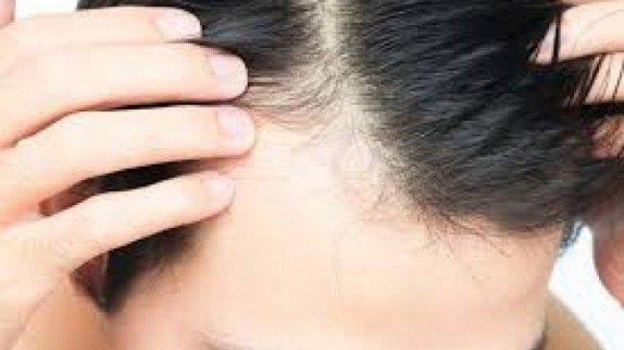 Ilustrasi masalah rambut mengalami kebotakan disebabkan oleh beberapa hal salah satunya pola makan yang buruk.