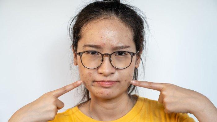 Wanita yang mengalami masalah jerawat di wajah.