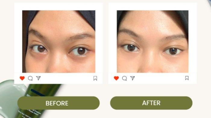 Hasil penggunaan Skin Dewi Horse Chestnut Dark Circle Eye Serum.