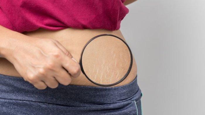 Ilustrasi seseorang dengan masalah stretch mark di kulit baian perut.