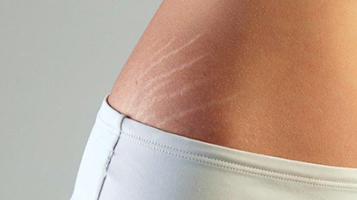 Ilustrasi seorang wanita yang mengalami masalah stretch mark pada bagian tubuh tertentu dapat dipudarkan menggunakan krim khusus atau perawatan medis.
