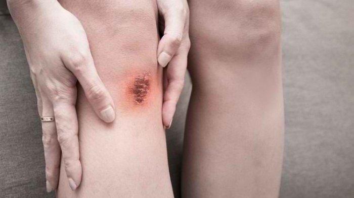 Tidak Mengelupas Koreng yang Menghitam