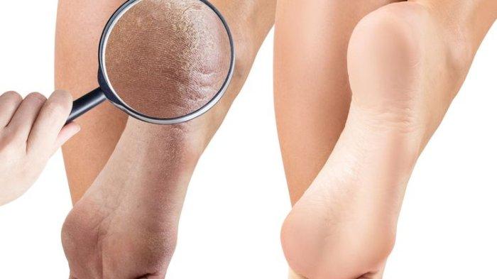 Tumit kaki pecah-pecah bisa diatasi dan halus kembali dengan bahan alami tawas.