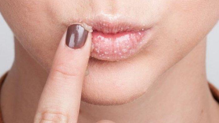 Ilustrasi mengeksfoliasi bibir.
