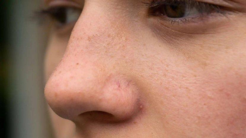 6 Cara Hilangkan Komedo Hitam Secara Permanen, Mulai dari Skincare Hingga Bahan Alami