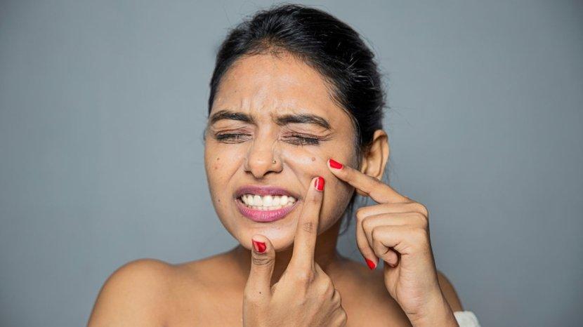 7 Bahaya Memencet Jerawat yang Tidak Boleh Disepelekan, Ada yang Bisa Mengancam Nyawa