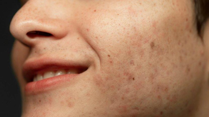 Tips Ampuh Atasi Flek Hitam Menurut Dermatologis, Salah Satunya Rajin Pakai Sunscreen