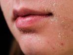 Alasan Kulit Sekitar Bibir Sering Terasa Kering, Ternyata Ini Penyebabnya