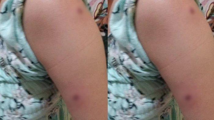 Bekas luka tembakan gadis yang ditembak pria misterius di Semarang, Jateng.
