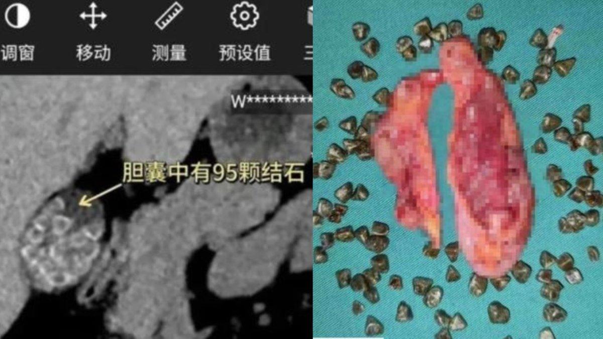 Ada 95 batu empedu ditemukan dalam tubuh seorang wanita di China, pemicunya sering melewatkan sarapan.