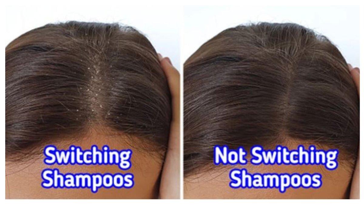 ANTI KETOMBE DENGAN SAMPO BIASA - membantu menghilangkan ketombe, mengurangi gatal di kulit kepala, menjaga kelembapan, mencegah iritasi dan membuat rambut lebih sehat.