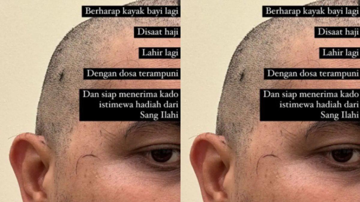 Arda Naff memilih mencukur habis rambut di kepalanya.