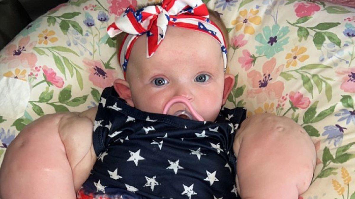 Armani Milby, bayi asal Kentucky, AS, lahir dengan tangan berukuran besar dan kekar layaknya Hulk.