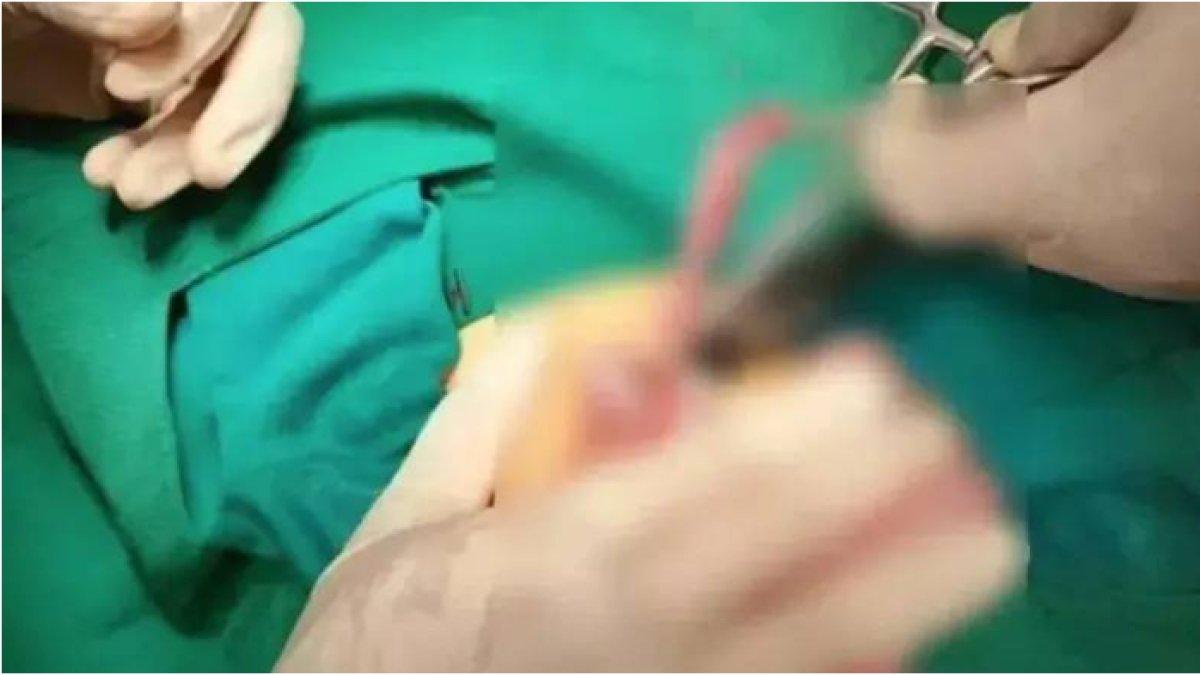 Balita dioperasi untuk mengeluarkan 8 jarum dari perutnya