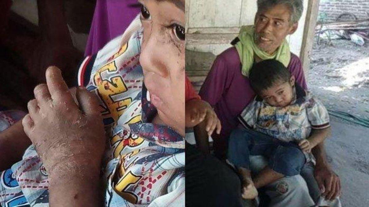 Balita penderita penyakit kulit langka