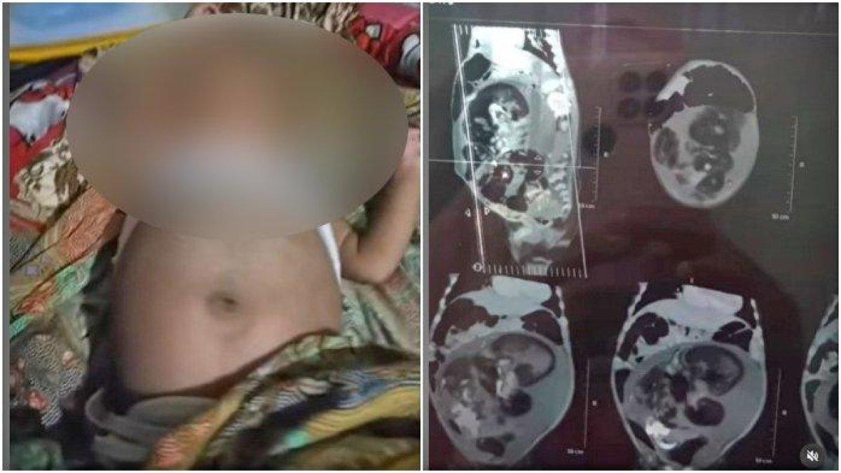 Inilah kabar terbaru soal bayi laki-laki di Sumatera Barat yang perutnya buncit dan diduga hamil. Dokter sebut itu tumor