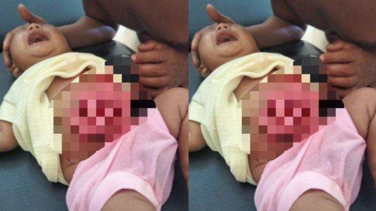 Bayi yang perutnya robek karena digigit monyet liar di Desa Parungsari, Kecamatan Wanasalam, Lebak, Banten.