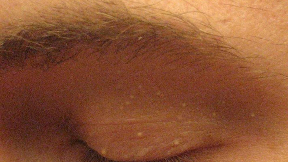 BENJOLAN KECIL - Milia adalah benjolan kecil putih di kulit akibat keratin terjebak. Tidak berbahaya dan sering hilang sendiri, tapi dokter bisa membantu jika tak kunjung memudar.