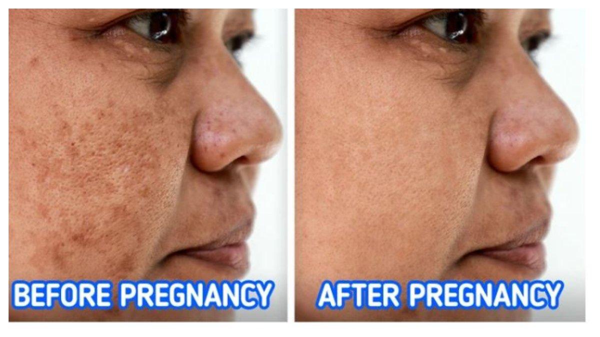WAJAH BERCAK GELAP - Melasma menyebabkan bercak gelap di wajah, sering terjadi pada wanita akibat hormon atau stres. Meski tidak berbahaya, perawatan bisa membantu memudarkannya.