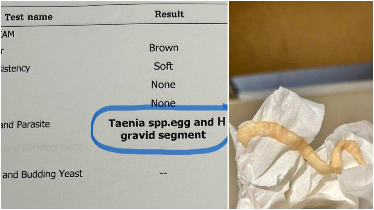 Cacing pita yang ada di dalam tubuh wisatawan Jepang.