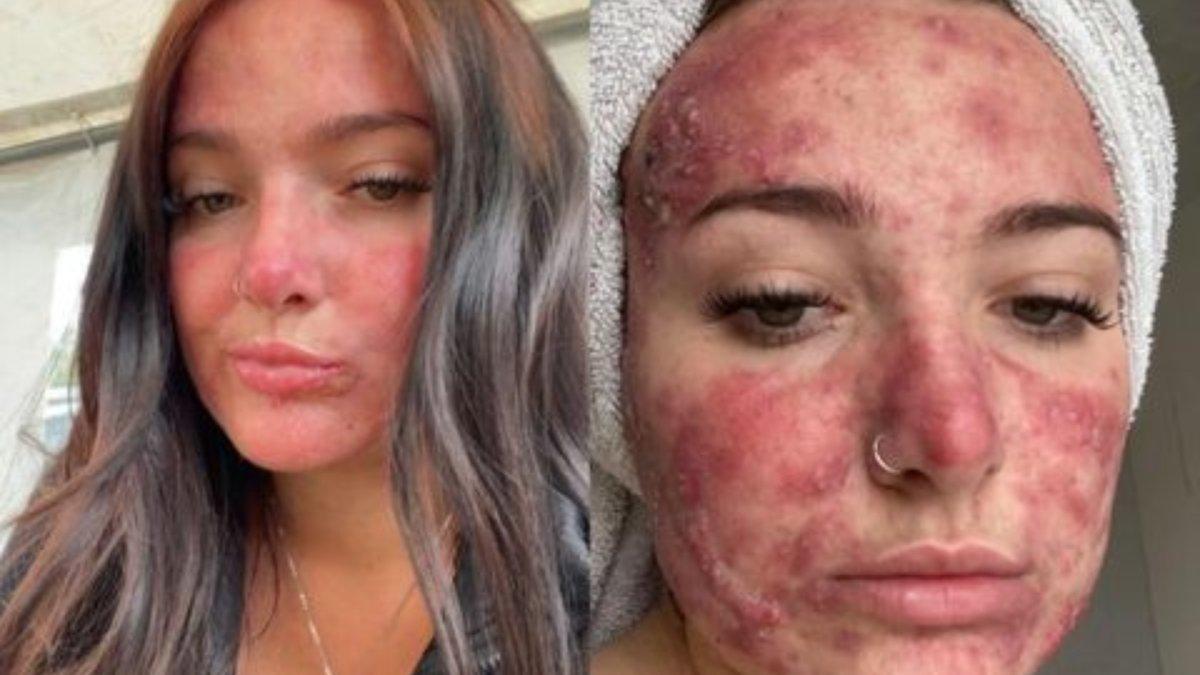 Courtney Jones tetap percaya diri buat konten meski wajahnya berjerawat parah.