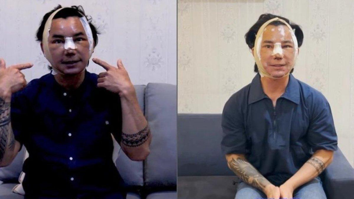 Eddy Siswanto permak wajah di Thailand