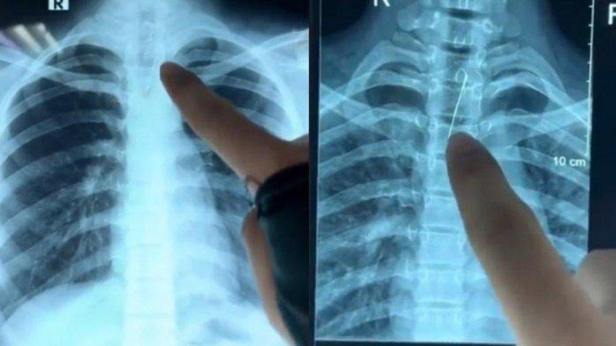 Hasil rontgen seorang wanita datang ke RSUD Kabupaten Jombang dengan keluhan yang tak biasa, ia ternyata menelan sebuah jarum pentul saat memakai jilbab
