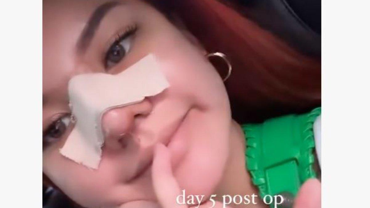 Ini adalah foto Shafa Harris setelah menjalani operasi plastik di hari ke-5.