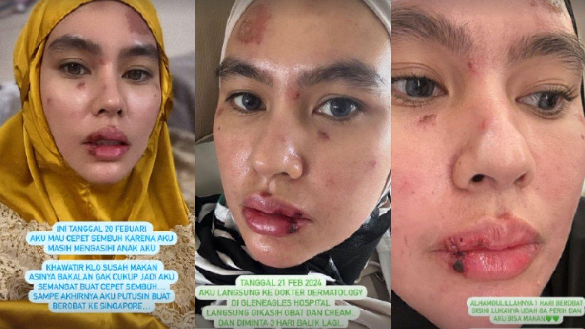 Inilah kabar terbaru Kartika Putri yang sempat alami kondisi misterius yakni ruam merah di wajah hingga lidah. Membaik setelah berobat ke Singapura.