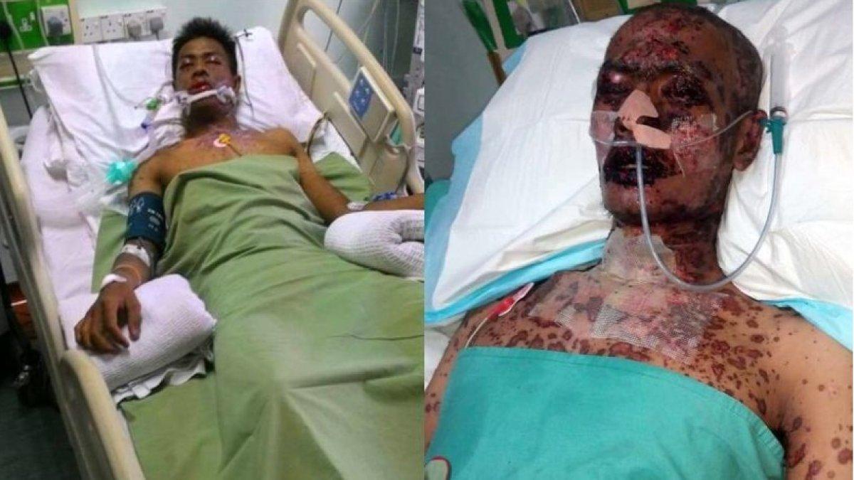 Istri pilu suami idap penyakit SJS, tetap setia menemaninya