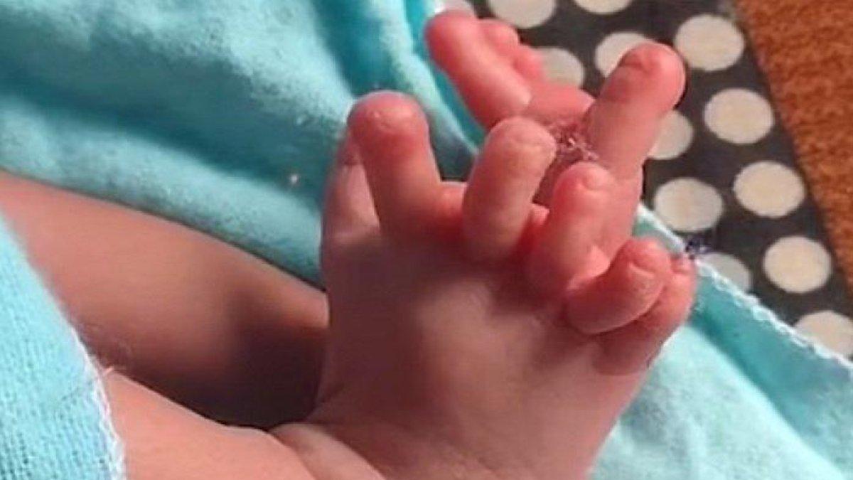 Jari Kaki Bayi di India Berjumlah 6