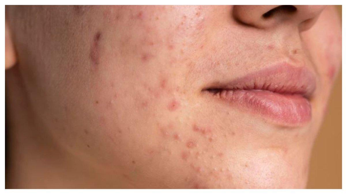JERAWAT YANG PARAH - Stres bisa memperburuk jerawat dengan meningkatkan kortisol yang merangsang produksi minyak. Atasi stres dengan rutinitas perawatan kulit, tidur cukup, olahraga, dan meditasi.