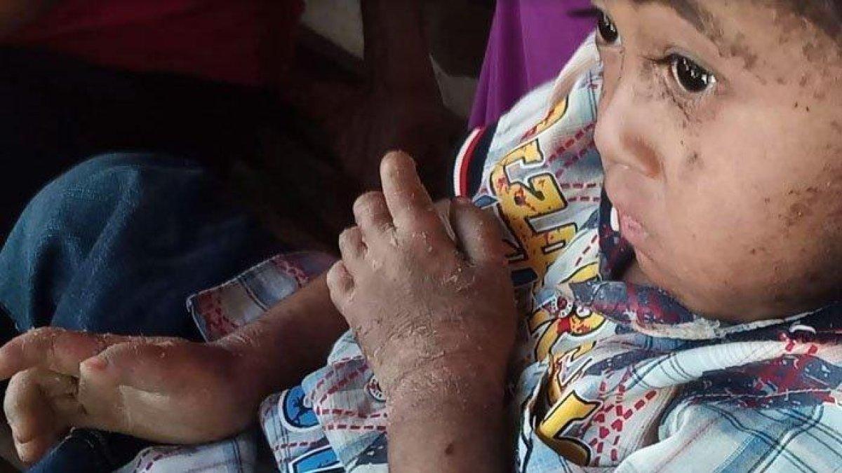 Kondisi kulit Alfi Azka (3)