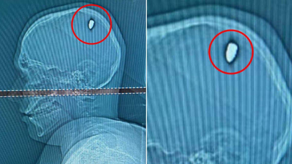 Mateus Facio, pria Brasil baru sadar kepalanya tertembak setelah 4 hari.