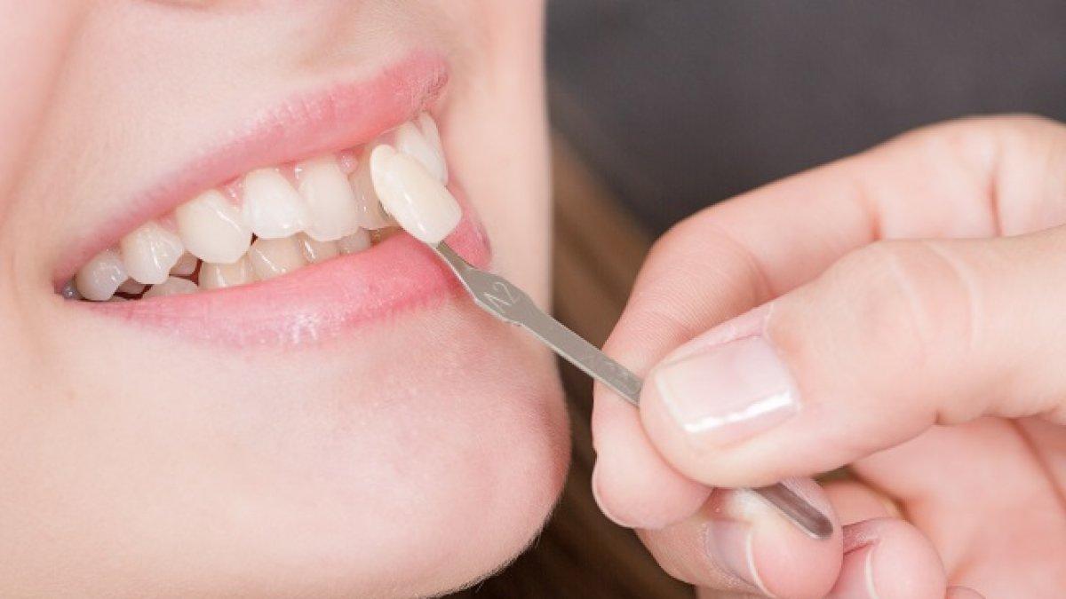 Membuat crown gigi cara mengatasi