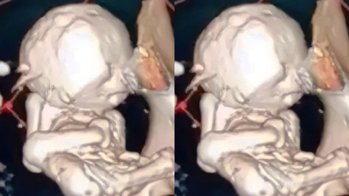 Penampakan janin di perut nenek berusia 73 tahun