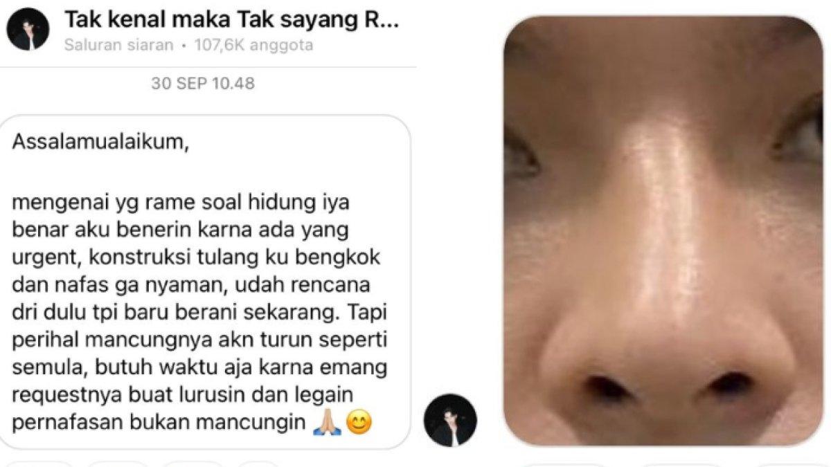Potret bentuk hidung Rey Mbayang sebelum jalani oplas