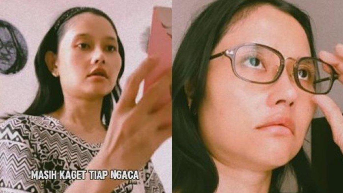 Potret terbaru Riyuka Bunga pasca oplas hidung