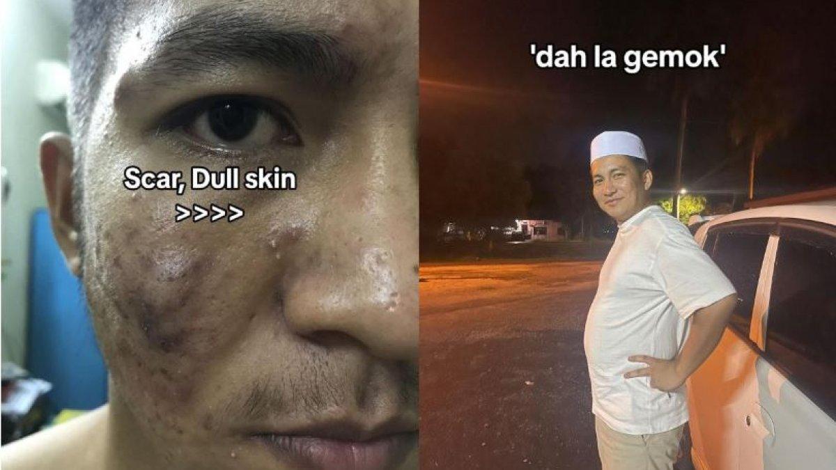 Viral Transformasi Pria Gemuk dan Berjerawat, Dulu Diejek Orang Kini