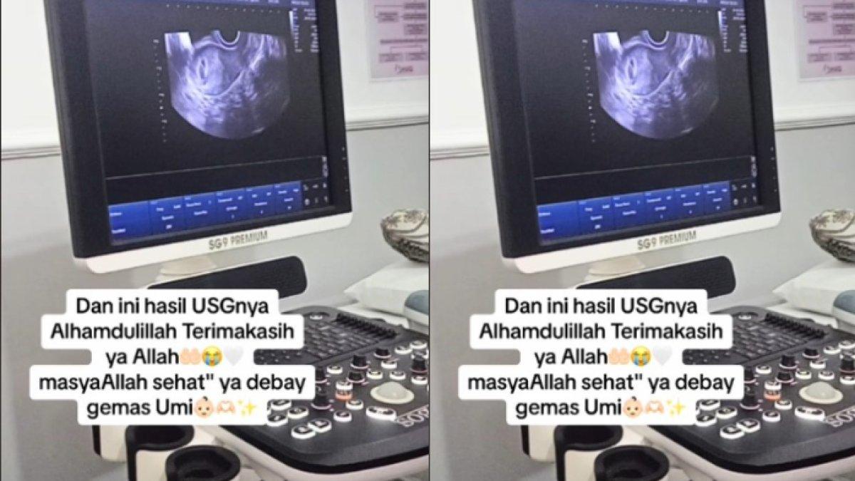 Rizky Ayu pamer hasil USG